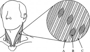 Trigger Points in Spieren
