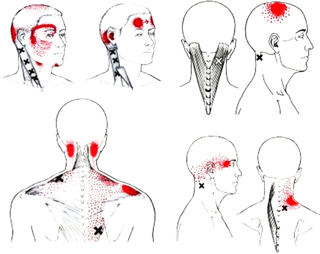 Triggerpoints & Hoofdpijn